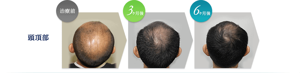 頭頂部