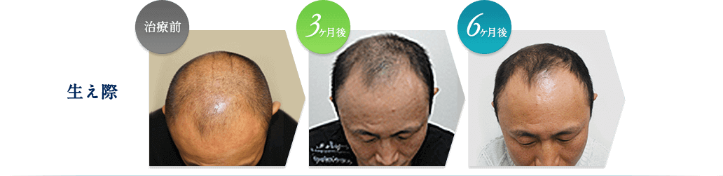 生え際