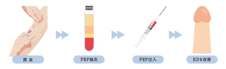ED向けのPRP治療